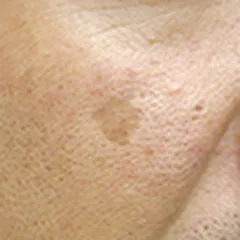 日光黒子（老人性色素斑）