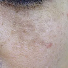 対称性真皮メラノサイトーシス（ADM）