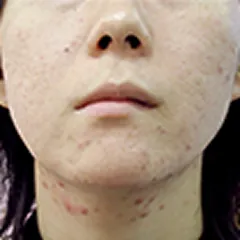 炎症後色素沈着