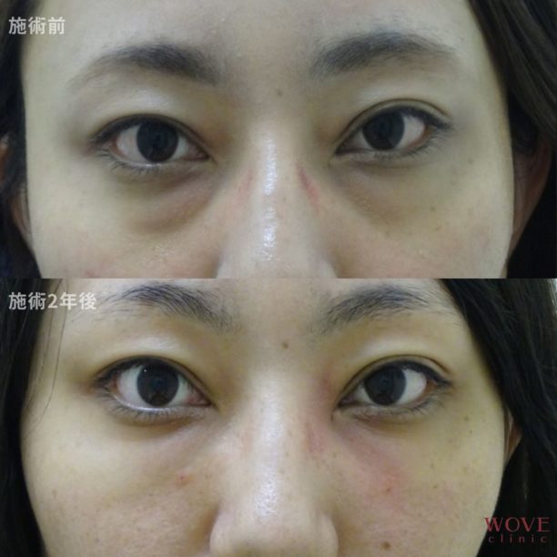 ヒアルロン酸注入3回（メンテナンス含む）