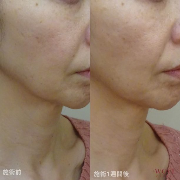 ヒアルロン酸注入（ジュビダームビスタ ボライトXC）（顔・首）1回　