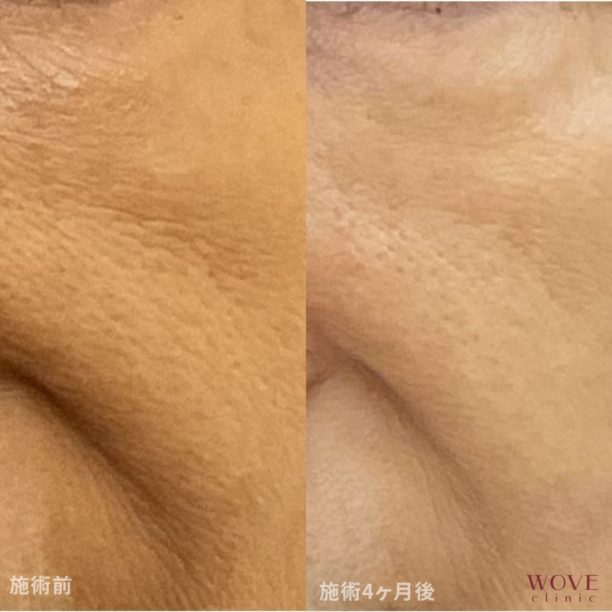 WOVE小じわ消し注射（全顔）1回（ジュビダームビスタボライトXC4本・スネコス注射＆マイクロボトックス注射1回・スネコス注射3回）