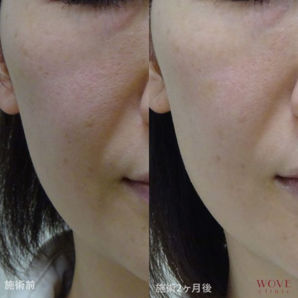 WOVE小じわ消し注射1回（ジュビダームビスタボライトXC2本・スネコス注射＆マイクロボトックス1回・スネコス注射3回）