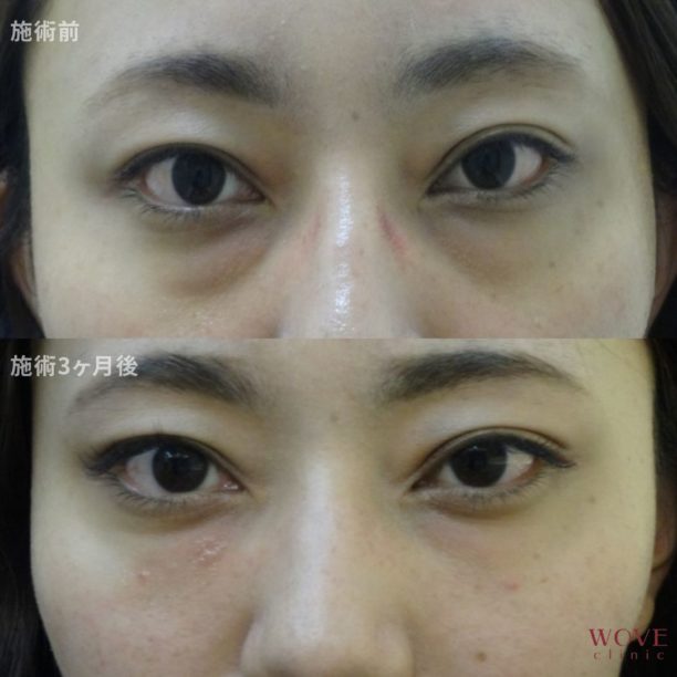 ヒアルロン酸注入（目元）1回