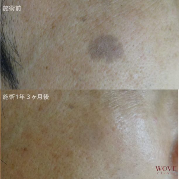 シミ取りレーザー1回