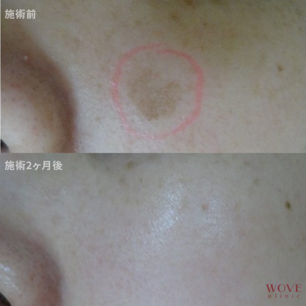 シミ取りレーザー1回