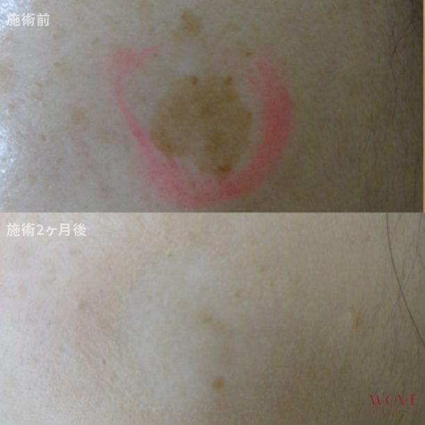 シミ取りレーザー1回