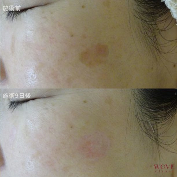 シミ取りレーザー1回