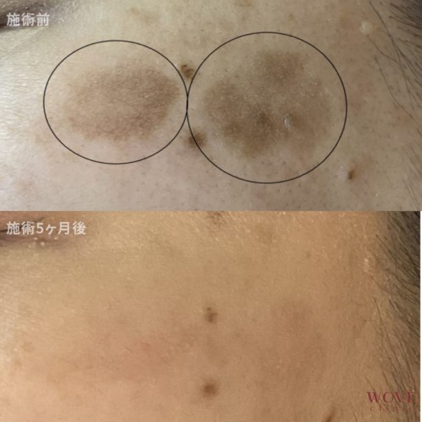 シミ取りレーザー1回・CO2レーザー（脂漏性角化症）1回