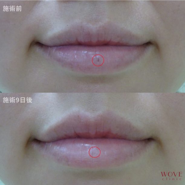 シミ取りレーザー1回