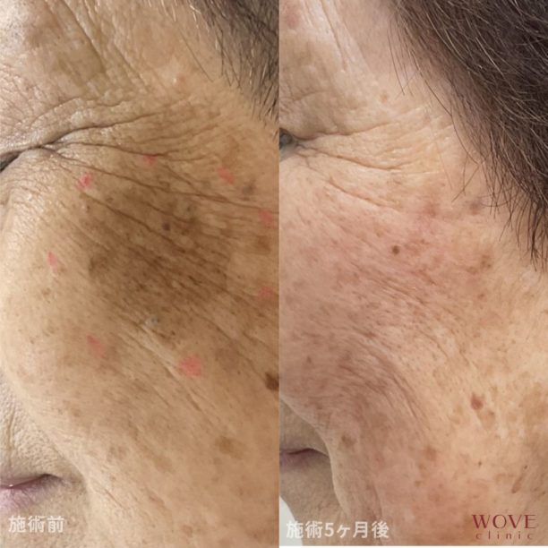 シミ取りレーザー1回