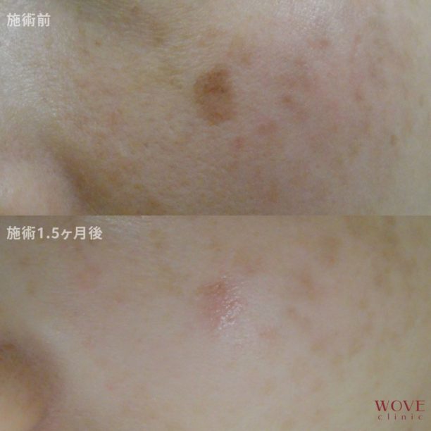 シミ取りレーザー1回