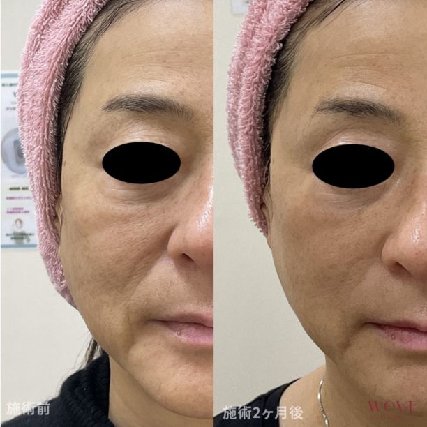 トリニティ（全顔）1回・ヒアルロン酸リフト1回