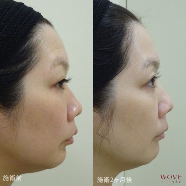 トリニティ（全顔）2回