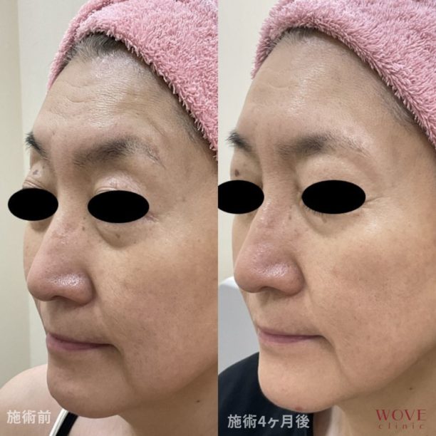 トリニティ（全顔）1回