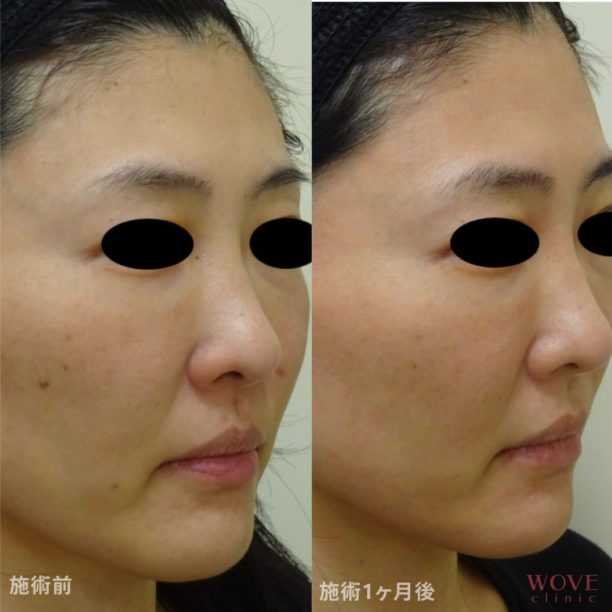 ピコダブル（全顔）1回