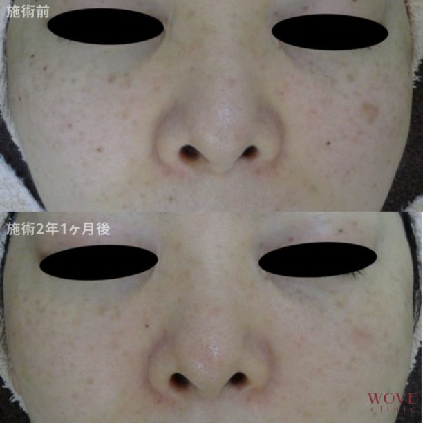 ケミカルピーリング＆フォトRFオーロラ＆導入（全顔）5回