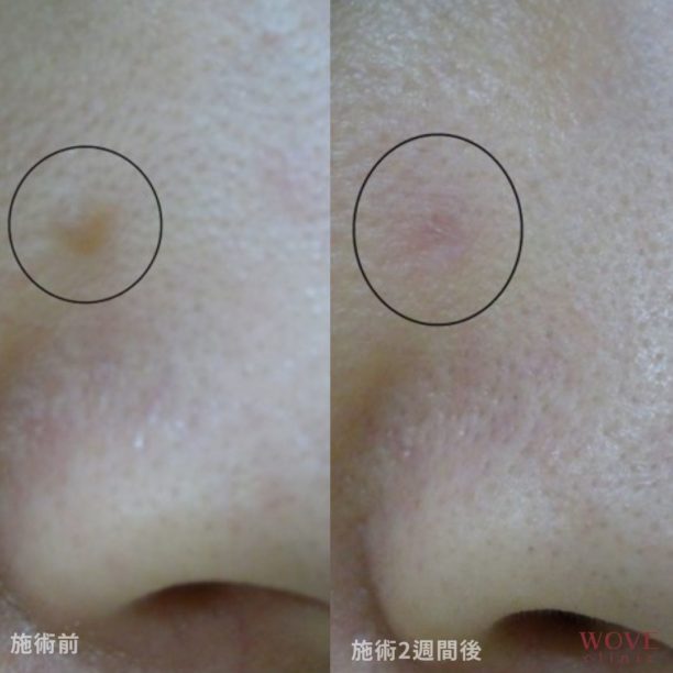 CO2レーザー（ホクロ）1回