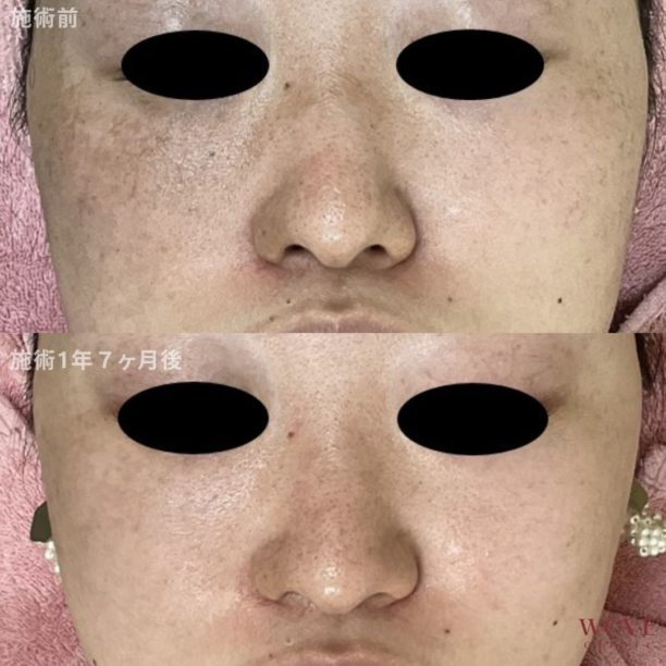 ADMレーザー（太田母斑）6回・肝斑レーザートーニング＆トラネキサム酸導入21回