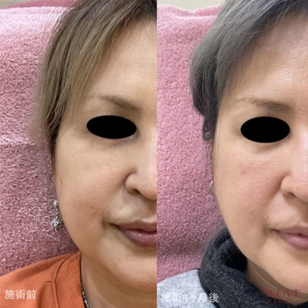 BNLS注射（両頬）5回