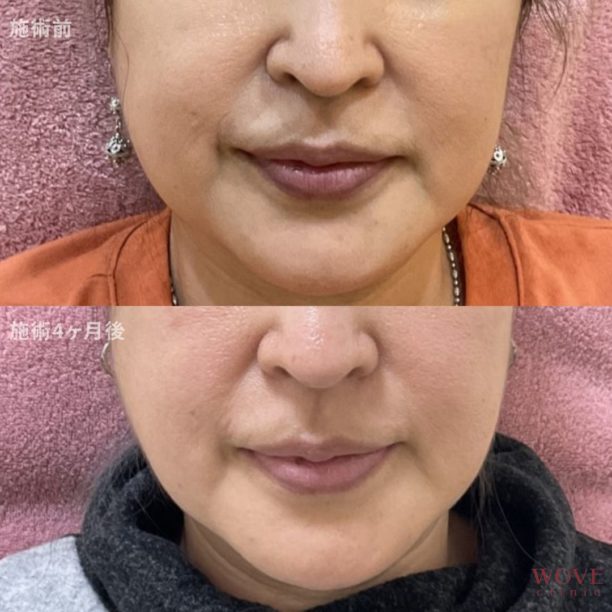 BNLS注射（両頬）5回