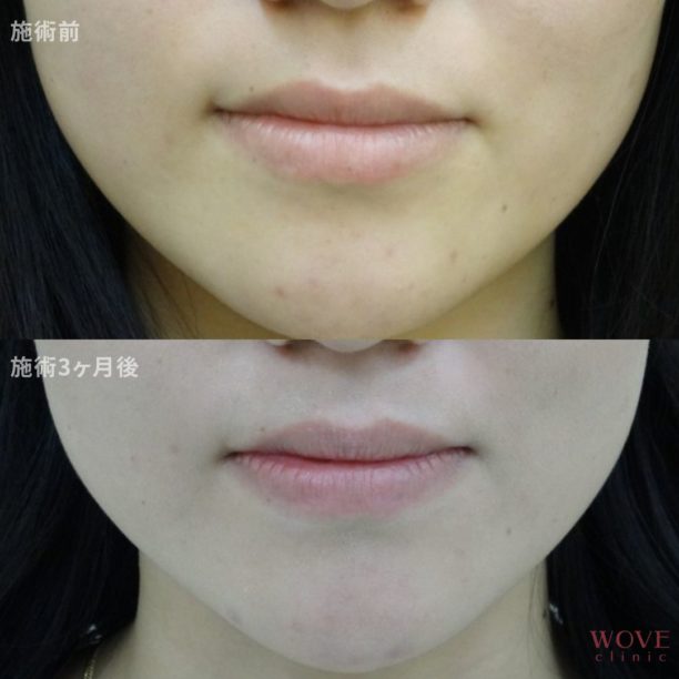 BNLS注射（両頬）6回