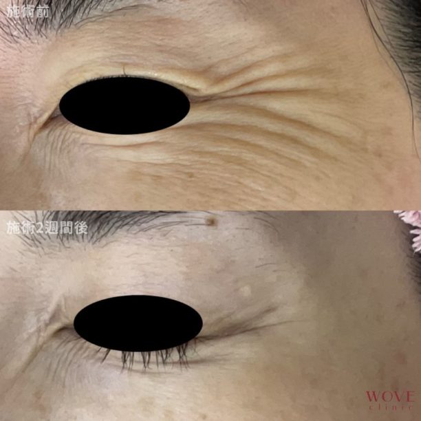 ボトックス注射（目尻）