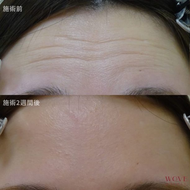 ボトックス注射（額）