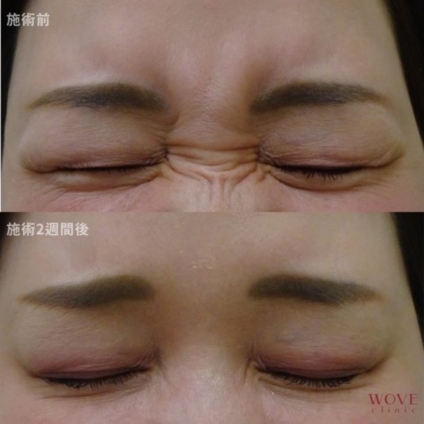 ボトックス注射（鼻根・眉間・目尻）