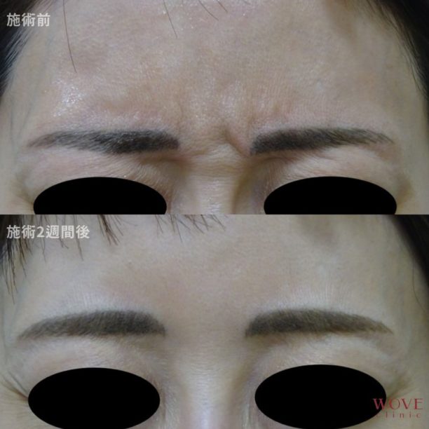 ボトックス注射（眉間）