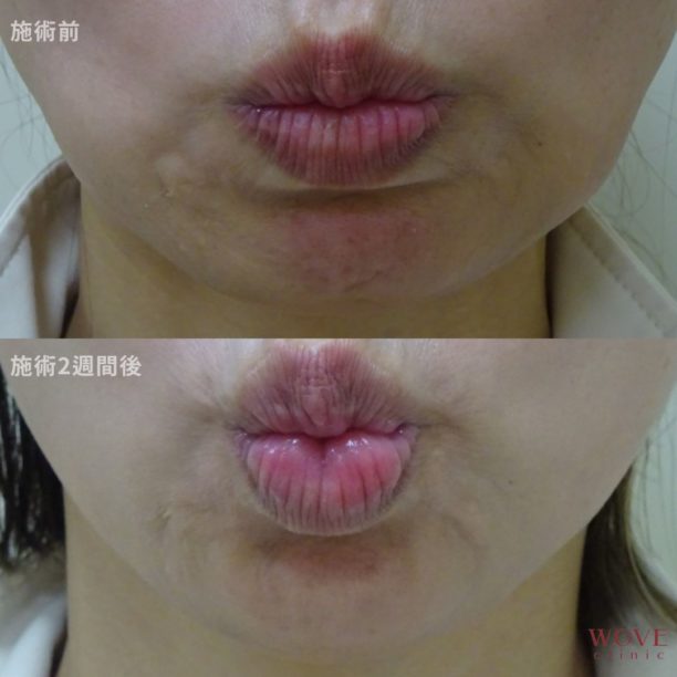 ボトックス注射（顎）