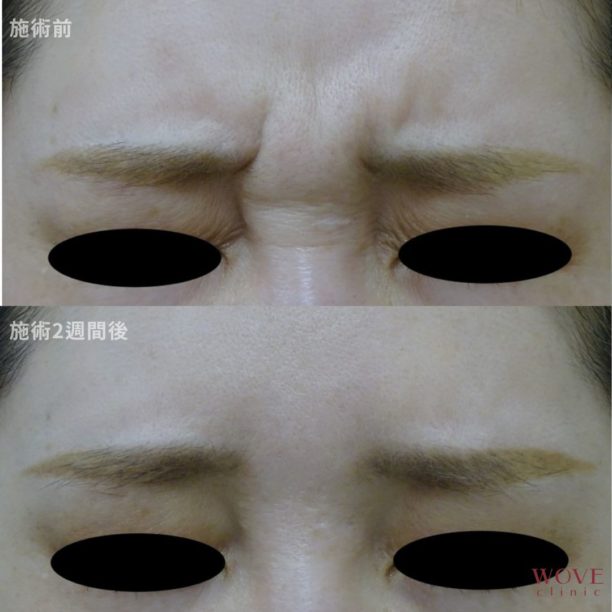 ボトックス注射（眉間）