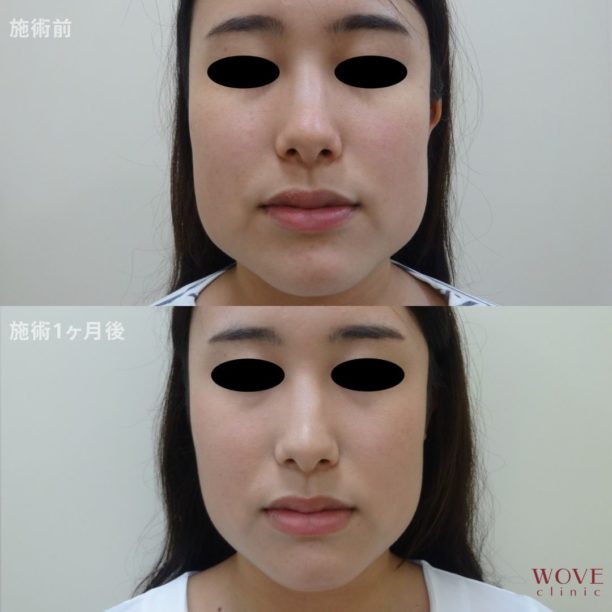 ボトックス注射（エラ）