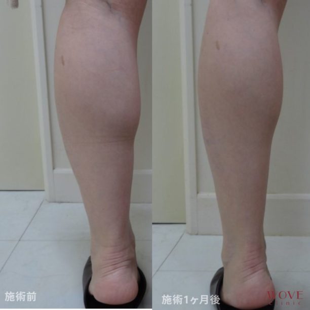 ボトックス注射（ふくらはぎ）