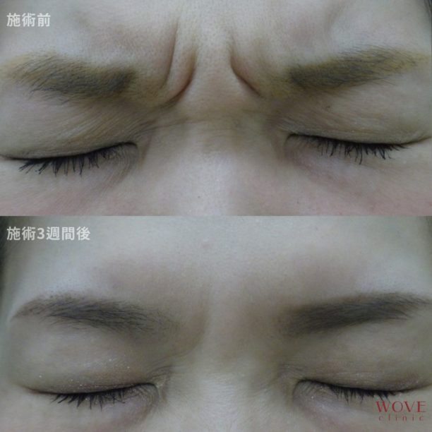 ボトックス注射（眉間）