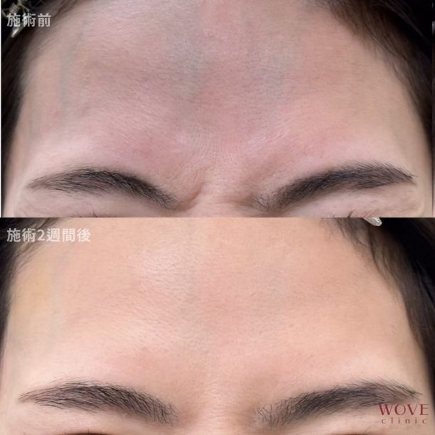 ボトックス注射（眉間）