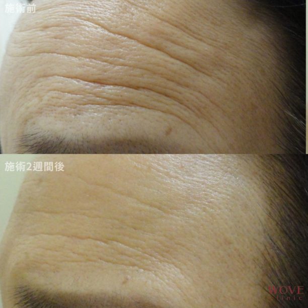 ボトックス注射（額）　