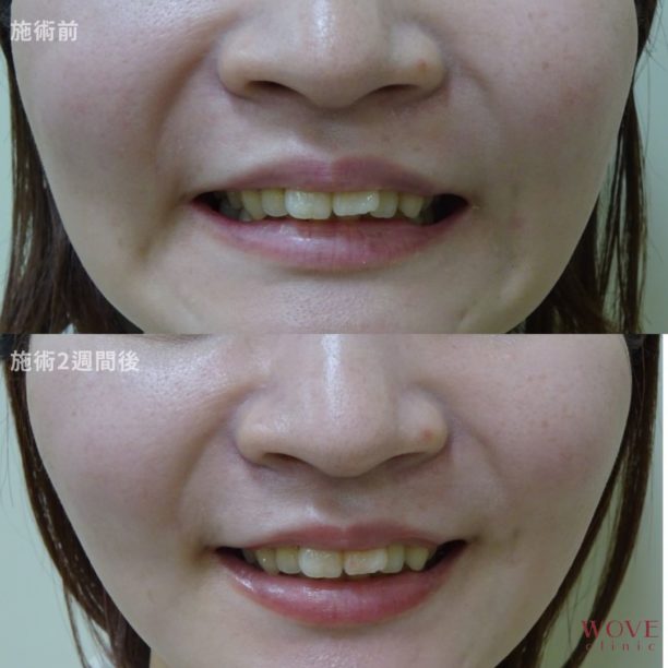 ボトックス注射（口角下制筋）　