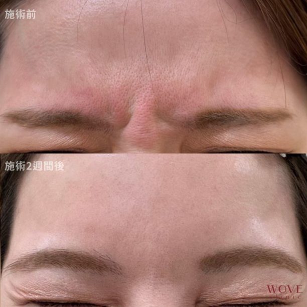 ボトックス注射（眉間）