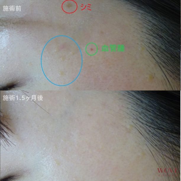 CO2レーザー（扁平疣贅・血管腫）1回・シミ取りレーザー1回　価格未