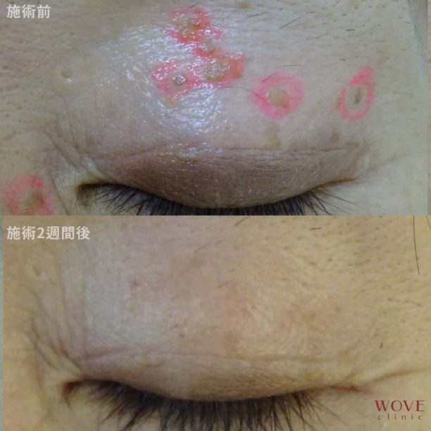 CO2レーザー　（脂漏性角化症）1回