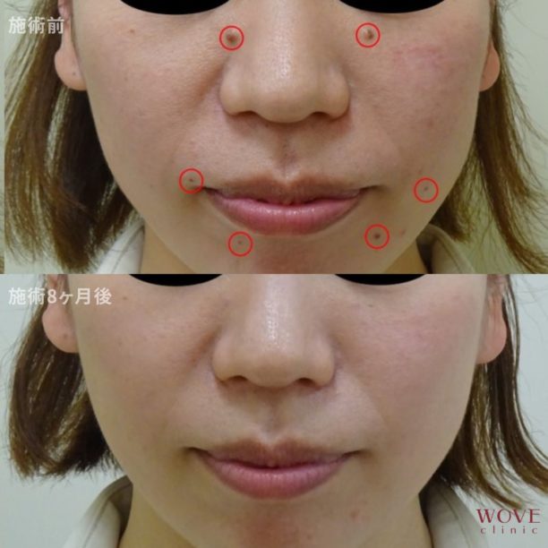 CO2レーザー（ホクロ）1回