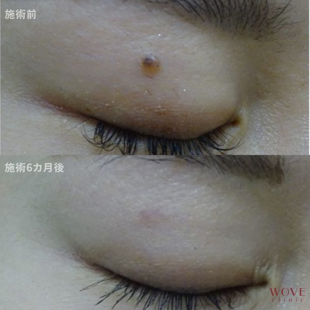 CO2レーザー（ホクロ）1回