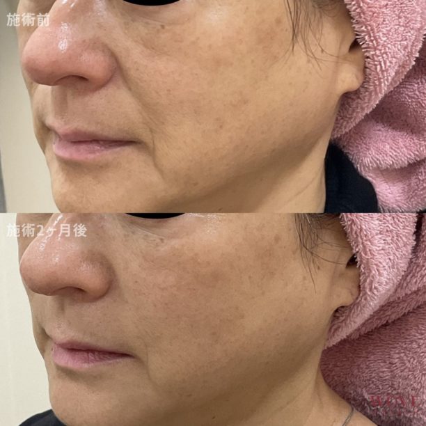 ヒアルロン酸リフト＆ヒアルロン酸注入（法令線）1回・トリニティ（全顔）1回