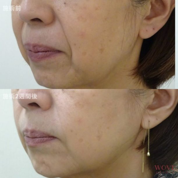 ヒアルロン酸リフト1回