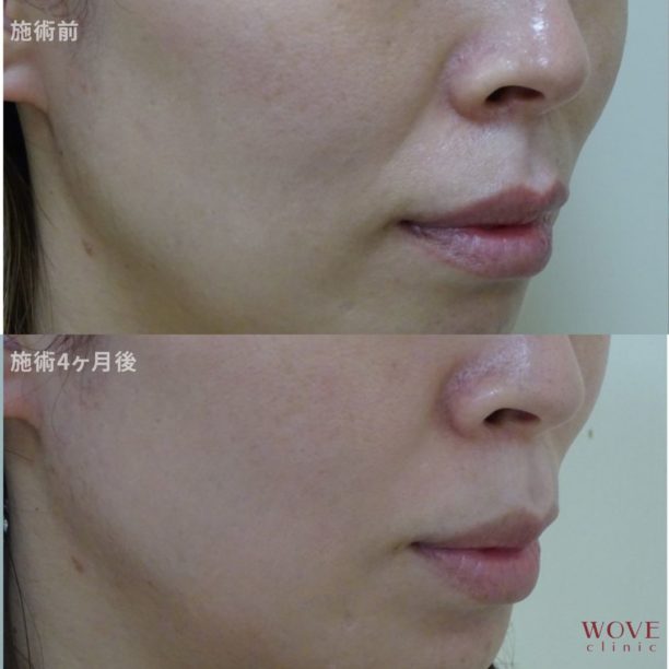 ヒアルロン酸注入（ジュビダームビスタボライトXC）（両頬）1回　