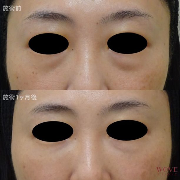 ヒアルロン酸注入（目元）1回