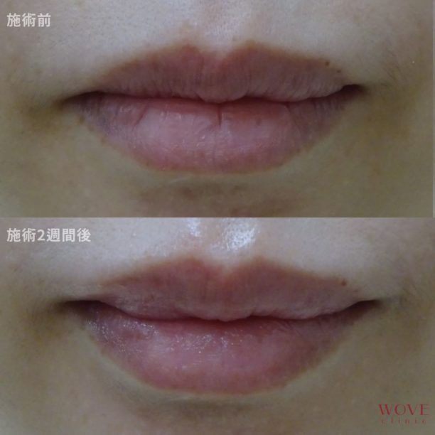 ヒアルロン酸注入（唇）1回
