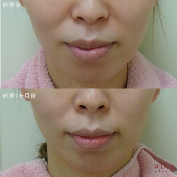 アドバンストHIFU（全顔＋顎下）1回