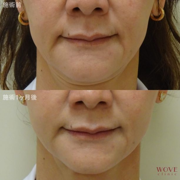 アドバンストHIFU（全顔＋顎下）1回